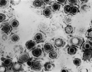 Herpes simplex virus particles as observed via transmission electron microscopy
