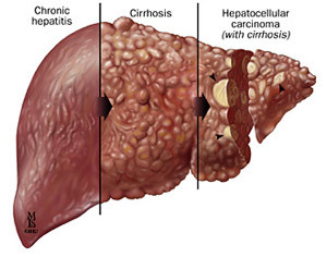 General progression of viral hepatitis in the liver